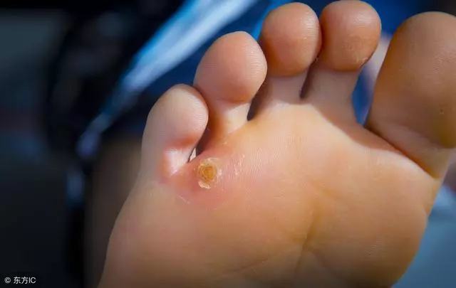雞眼是扎刺還是病毒?去雞眼真要在腳底挖洞嗎?