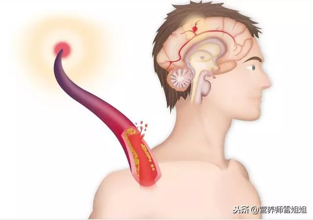 冬季,防腦卒中,8個「危險」信號,出現3個以上,最好去查查!