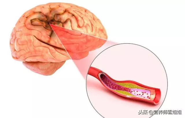 冬季,防腦卒中,8個「危險」信號,出現3個以上,最好去查查!