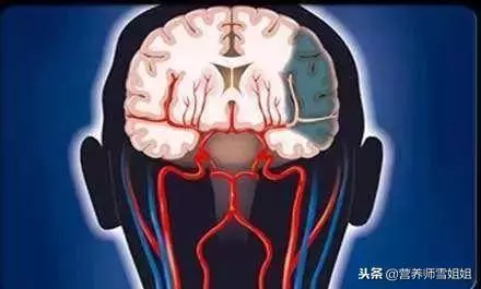 冬季,防腦卒中,8個「危險」信號,出現3個以上,最好去查查!