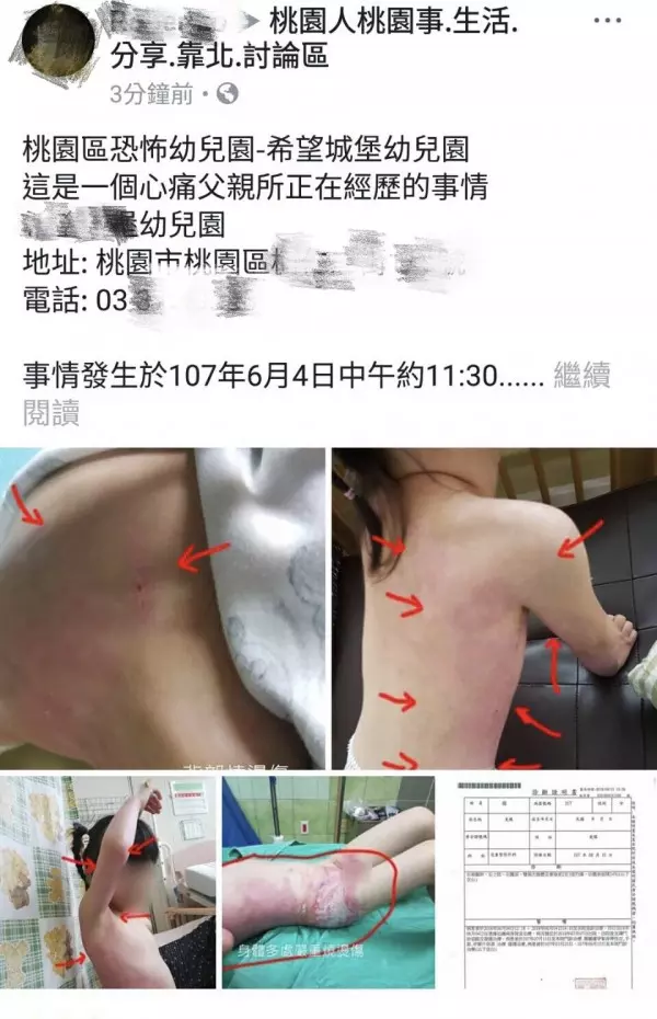 「恐怖幼兒園?」女童燙傷住進加護病房
