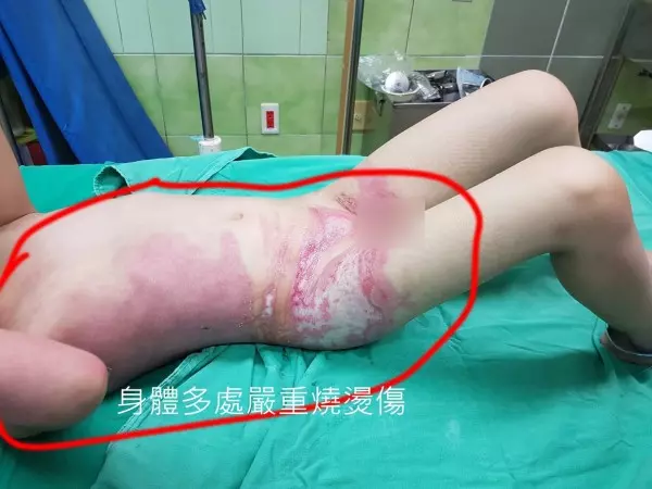 「恐怖幼兒園?」女童燙傷住進加護病房