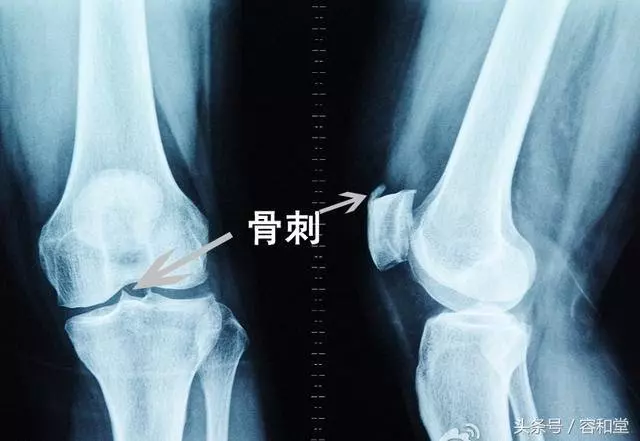 長骨刺免看醫生,獨家秘方讓你脫離苦海!有需要的朋友可不要錯過了!