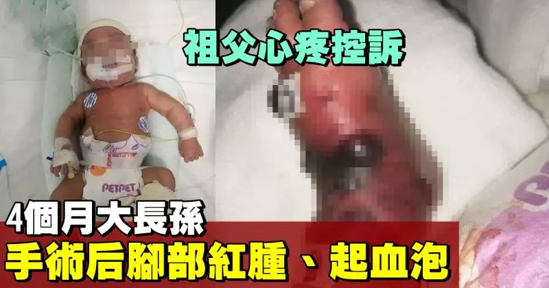 【心疼】長孫手術後腳部紅腫 ,祖父面書投訴引熱議!