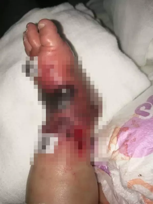 【心疼】長孫手術後腳部紅腫 ,祖父面書投訴引熱議!