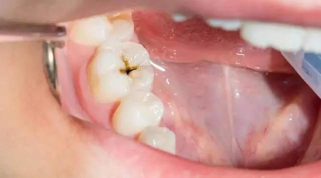 越早治越省錢!這種常見病,照照鏡子就能發現