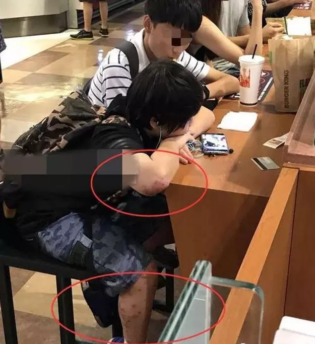 他兩歲出道拍戲被父母當搖錢樹,今13歲皮膚潰爛讓人心疼
