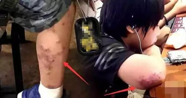 他兩歲出道拍戲被父母當搖錢樹,今13歲皮膚潰爛讓人心疼