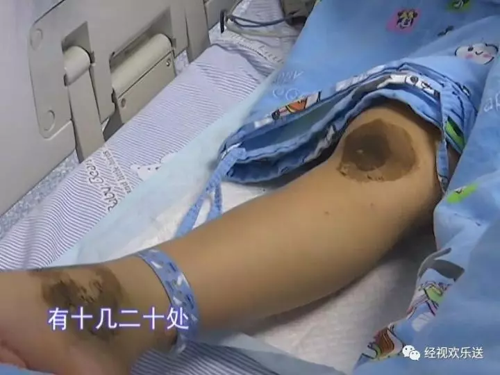 「爸爸,我不治了,給我買雙新鞋和一身新衣服就好。」 8歲女童被馬蜂群蜇,求家人放棄!…