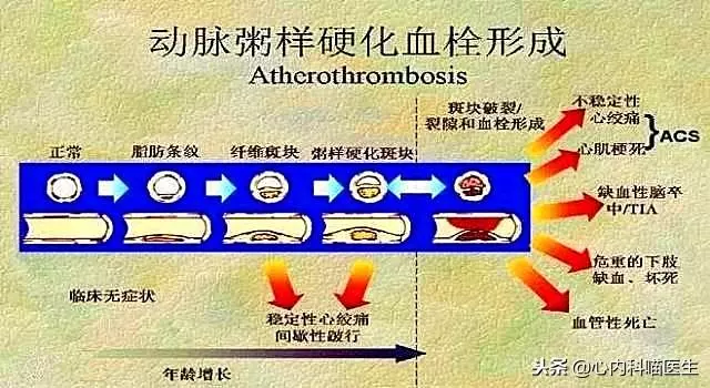 「血管健康」到「心梗猝死」只需要三步,不要任其發展