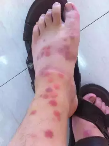 兩個月狗狗渾身黑點,主人接觸後身上奇癢無比