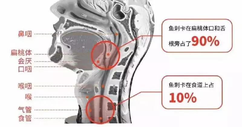 被魚刺卡住喝醋?當心要了你的命!