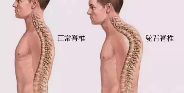 如何消除「圓肩」和駝背?6個動作,堅持一個月,體態明顯改善!