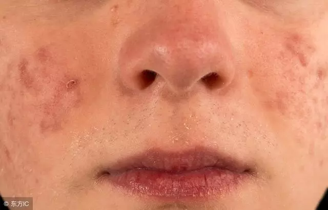 肝不好會有5種皮膚問題,不吃藥的5個養肝方,堅持做皮膚會好
