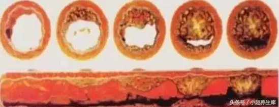 三處血管堵的十大表現,若一個都不占,說明你的「血管」還算健康