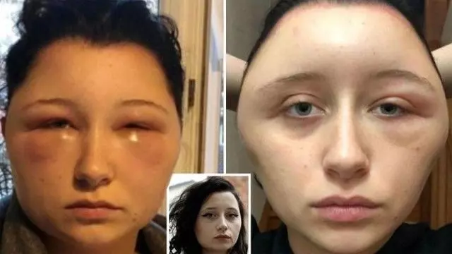 【不要在家亂染!】19歲正妹用DIY染髮劑染髮!頭腫成豬頭還差點丟命!