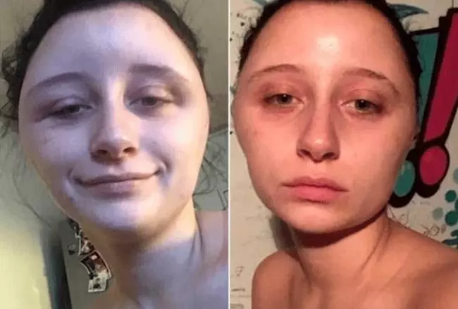 【不要在家亂染!】19歲正妹用DIY染髮劑染髮!頭腫成豬頭還差點丟命!