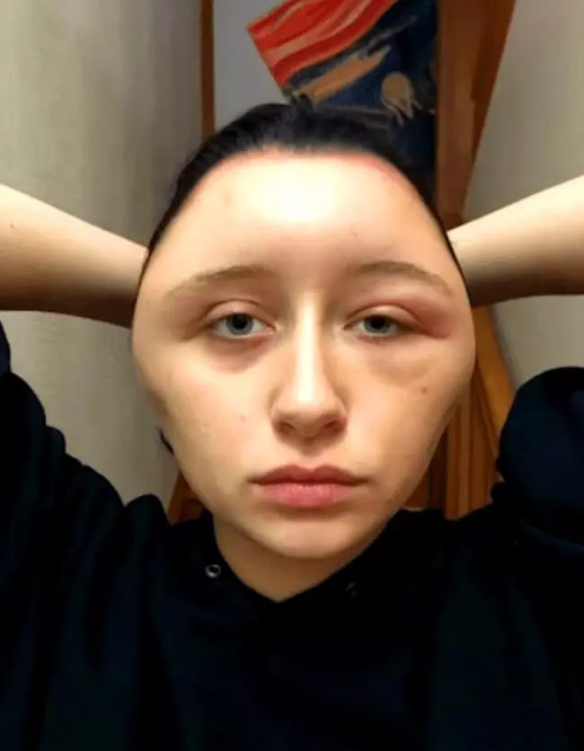 【不要在家亂染!】19歲正妹用DIY染髮劑染髮!頭腫成豬頭還差點丟命!