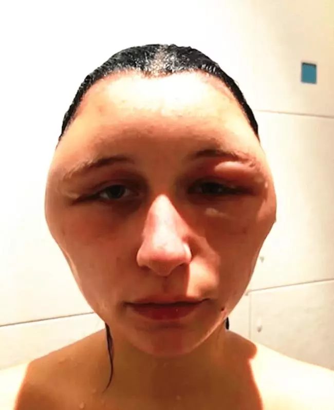 【不要在家亂染!】19歲正妹用DIY染髮劑染髮!頭腫成豬頭還差點丟命!