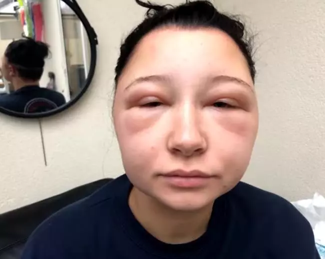 【不要在家亂染!】19歲正妹用DIY染髮劑染髮!頭腫成豬頭還差點丟命!