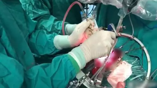 開頭顱手術做到一半 病患被喚醒唱歌