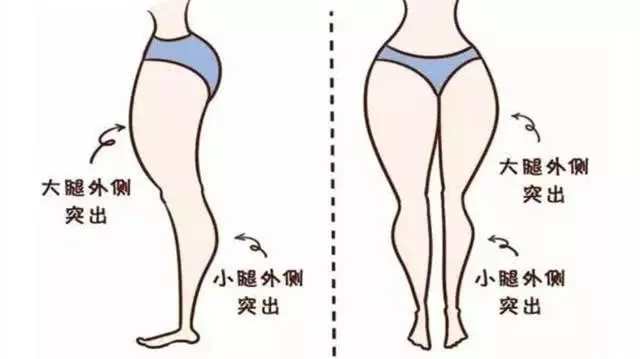 大腿外側突出是怎麼回事?還能瘦嗎