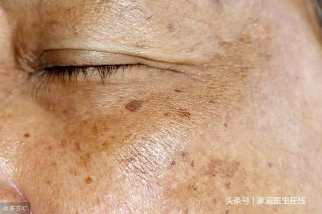 為什麼臉上越來越多黃褐斑?與3個因素有關,第一個最無奈