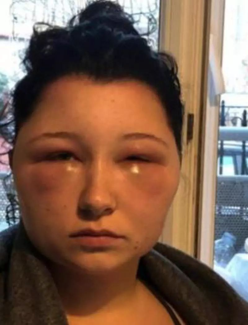對染髮劑敏感,法國女學生「臉部腫脹」,慘變「燈泡頭」:「我差點死掉!」