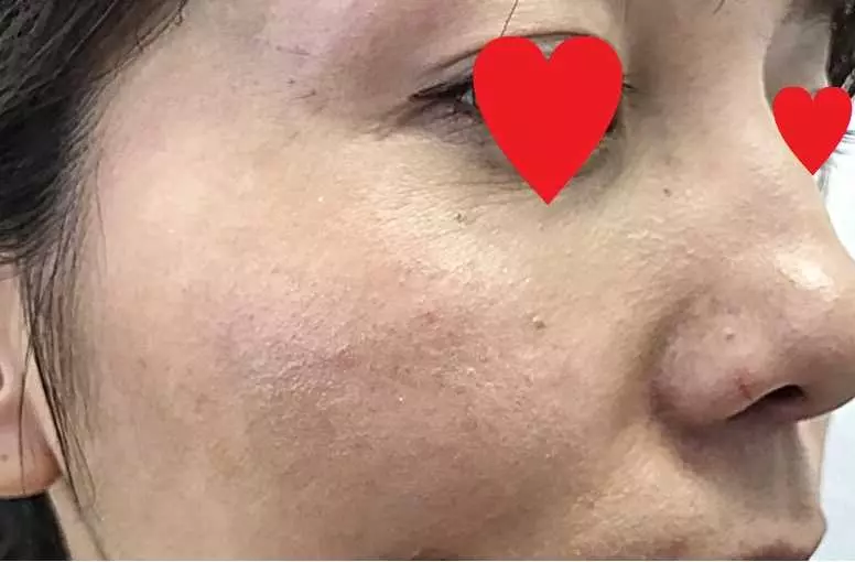 【告別眼周和脖子上的惱人脂肪粒!只花了1個月姊妹倆的皮膚都變得超光滑!