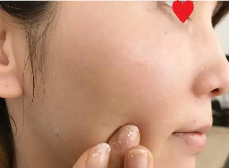 【告別眼周和脖子上的惱人脂肪粒!只花了1個月姊妹倆的皮膚都變得超光滑!