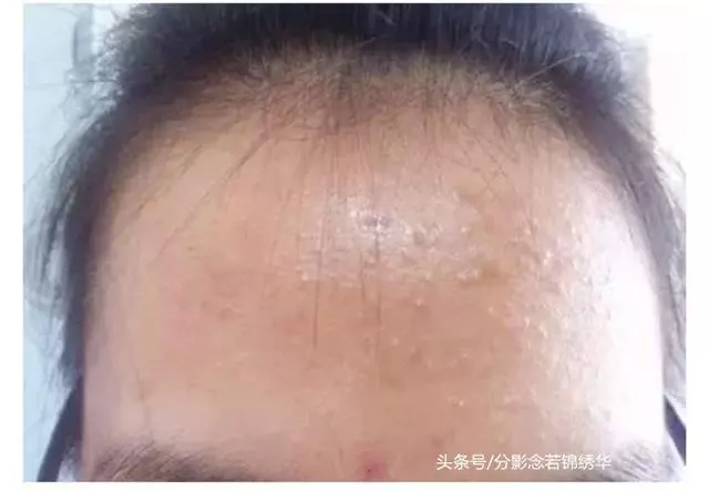 臉上這些像痘痘又摳不掉的東西是什麼?這篇文章告訴你,有的快收藏!