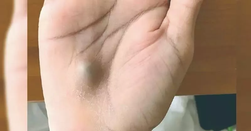 他看完牙醫「手上長出藍色小球」!6周「體重掉12公斤」醫生嚇傻:晚一步就死定了!