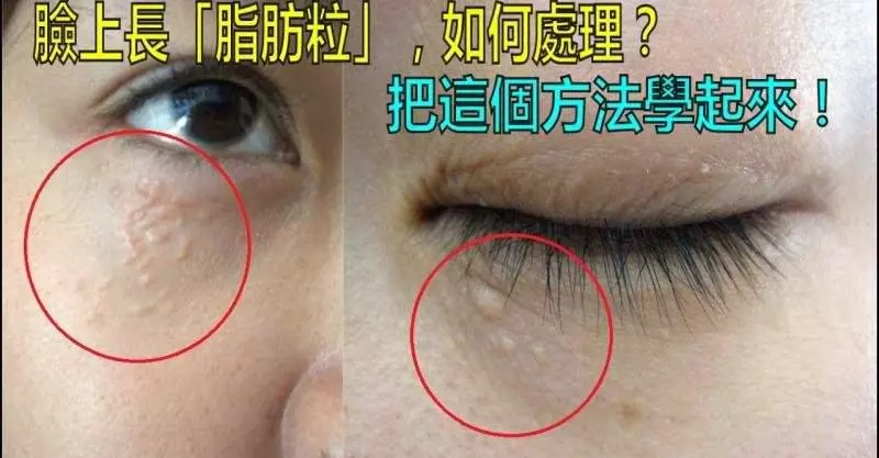 臉上長脂肪粒不要用手擠!教你3個小妙招,就能快速去除脂肪粒