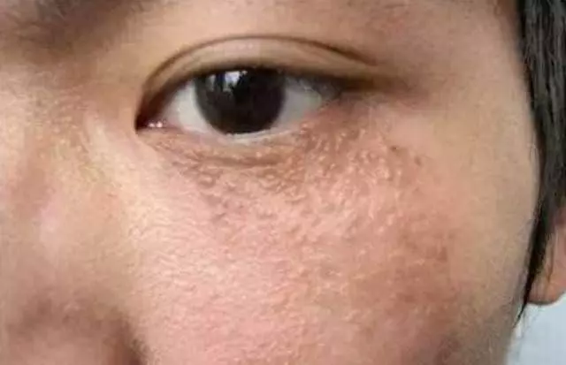 臉上長脂肪粒不要用手擠!教你3個小妙招,就能快速去除脂肪粒