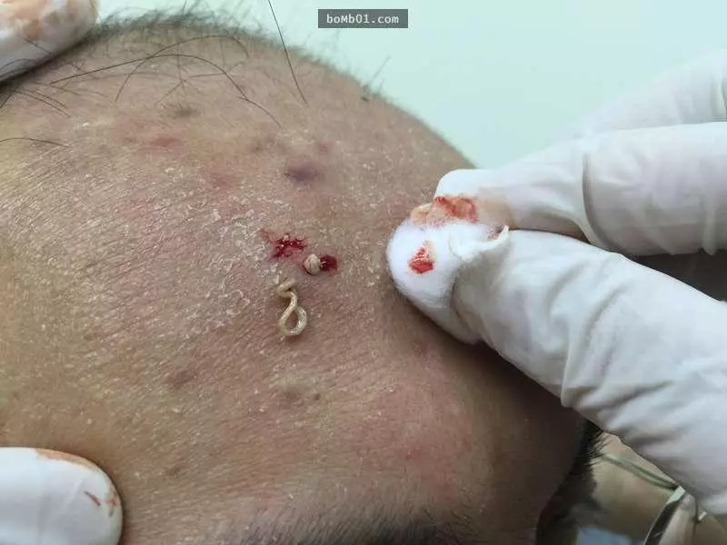 擠痘痘時流出來的「白色物質」到底是什麼?原來這就是我們不能任意自己擠痘痘的重大原因!
