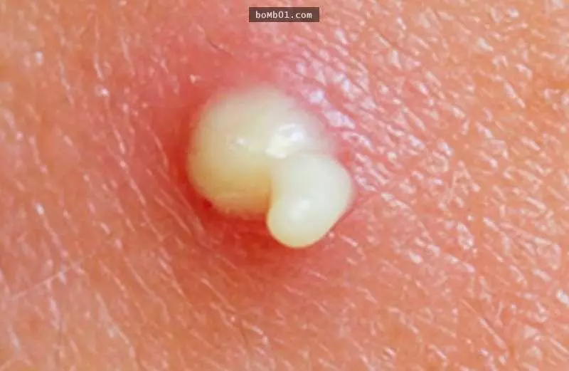 擠痘痘時流出來的「白色物質」到底是什麼?原來這就是我們不能任意自己擠痘痘的重大原因!