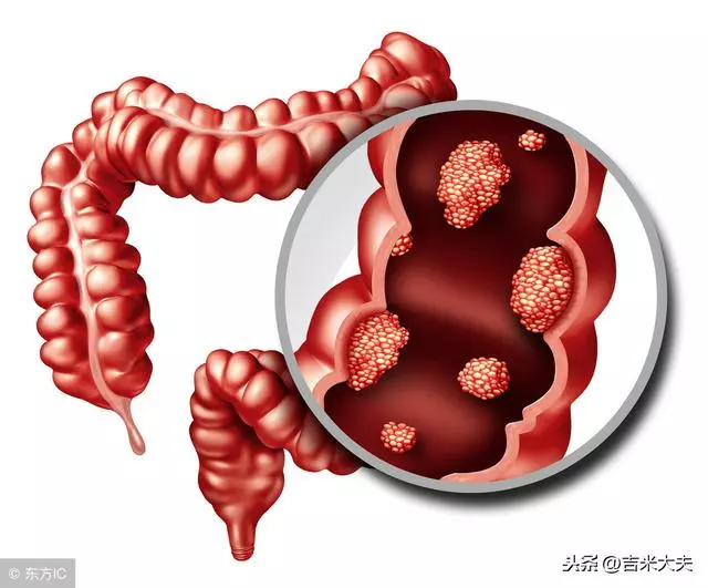 便秘久了會得腸癌嗎?可能你一直都弄錯了,問題並不這麼簡單!