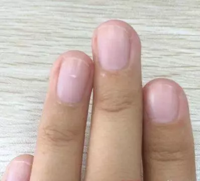 腎不好,指甲上會出現這4個信號!教你兩招,養腎抗衰老!