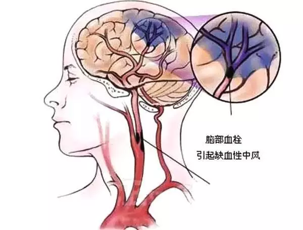 這根血管連通大腦最容易堵!很多人半身不遂之後才發現!慶幸的是,你現在看到這篇文章