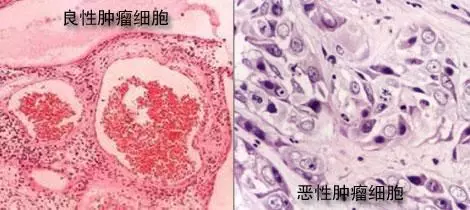 腫瘤的剋星,竟然是一種野菜,富含7種抗癌物質,終於被重視