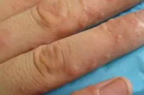 手上長了好多小水泡,還很癢!速速教你搞定它!