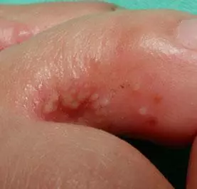 手上長了好多小水泡,還很癢!速速教你搞定它!