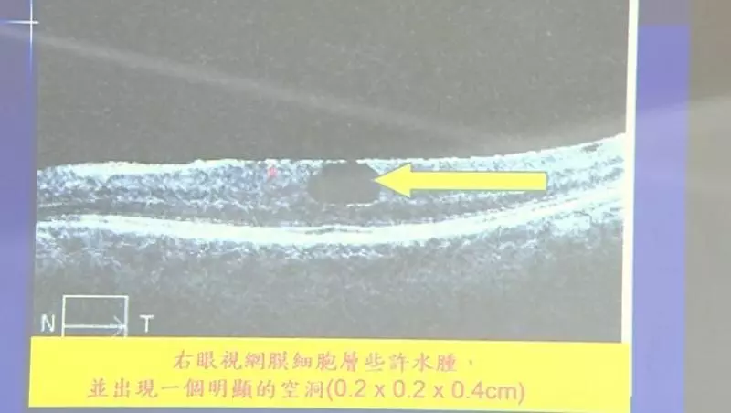 全世界第1個!常在大太陽底下滑手機 高雄妹子視網膜被「反射燒出一個洞」