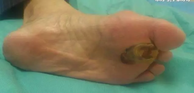 內科醫生提醒:腳上出現4個跡象,暗示你的血糖太高了!