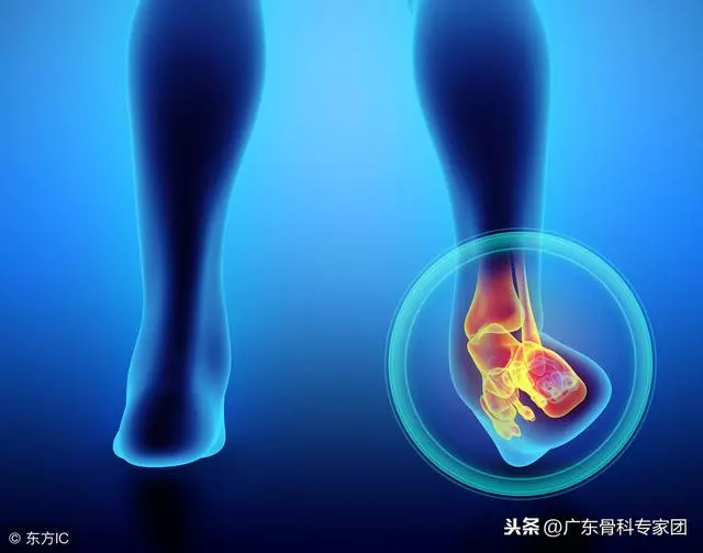 扭傷和拉傷是一回事嗎?處理方法做不對後果都很糟