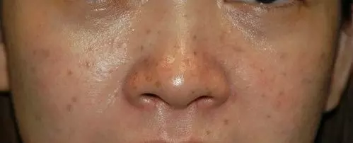 老年斑不用怕,一碗水幫你輕鬆祛斑,無副作用不反彈