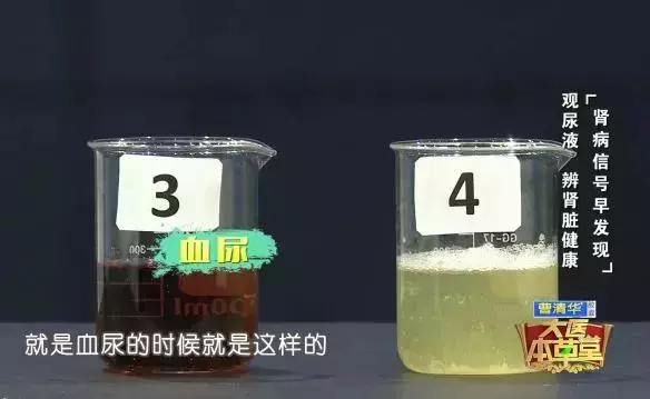 一定不要這樣喝水,會「毀掉」自己的腎,出現這種症狀表示腎臟受損