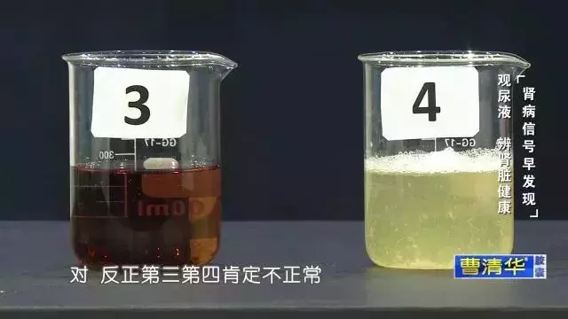 一定不要這樣喝水,會「毀掉」自己的腎,出現這種症狀表示腎臟受損