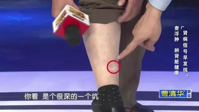 一定不要這樣喝水,會「毀掉」自己的腎,出現這種症狀表示腎臟受損