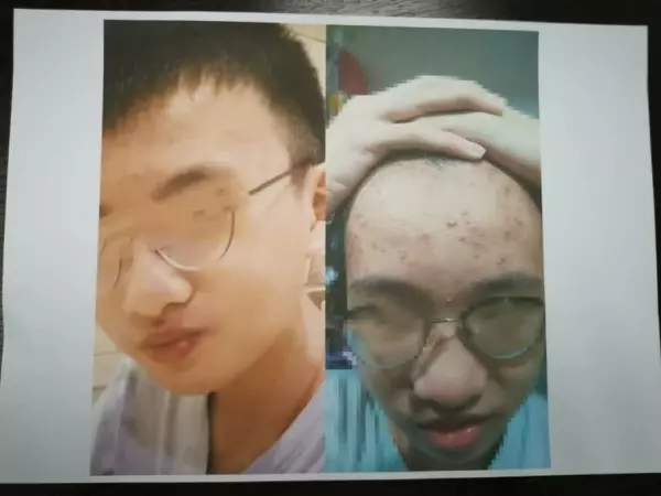 護膚品停用後產生副作用 料500人遭殃!